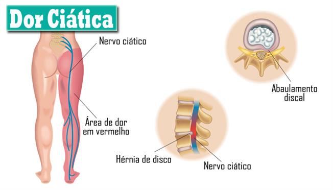 Que tomar para ciatica